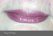 images/Referenzen/lippen/Foto_A_2.png