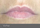 images/Referenzen/lippen/Foto_B_1.png