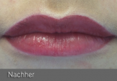images/Referenzen/lippen/Foto_B_4.png