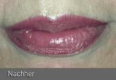 images/Referenzen/lippen/Foto_B_8.png