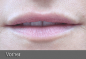 images/Referenzen/lippen/Foto_C_1.png