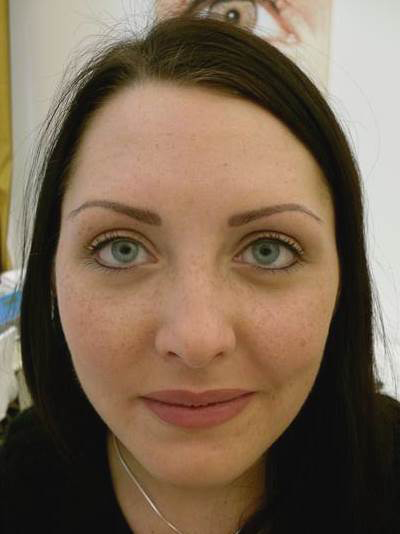 nach der Pigmentierung